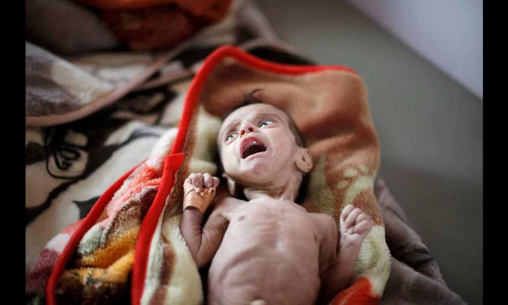 Υεμένη: Ολόκληρη γενιά παιδιών θα χαθεί από την πείνα